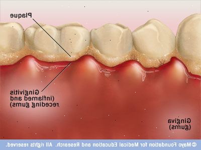 Hvordan forhindre gingivitt. Gå se dine eller tannpleier hvert halvår.