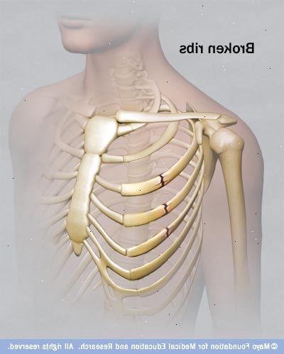 Hvordan å behandle brukne ribben. Se etter følgende symptomer for å avgjøre om du har brukne ribben.