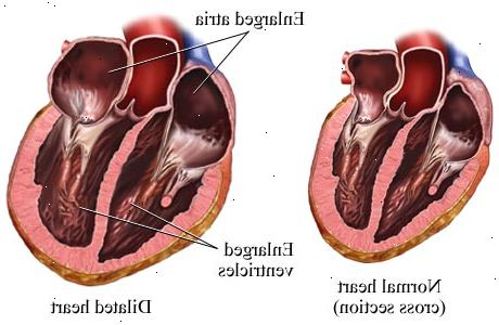 Hvordan å behandle en forstørret hjerte. Ta angiotensin-converting enzyme (ACE) hemmere, som foreskrevet.