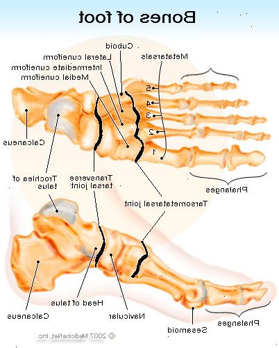 Hvordan å behandle en brukket fot. Gjenkjenne et brukket bein av følgende symptomer.