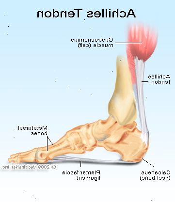 Hvordan diagnostisere hælspore. Sjekk dine hæler for noen benete vekst som stikker ut fra under huden.