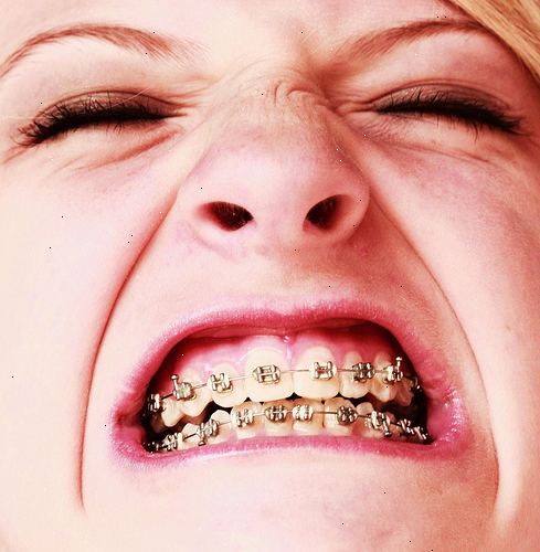 Hvordan takle å ha tannregulering. Godta det faktum at du sannsynligvis ikke får ut av det.