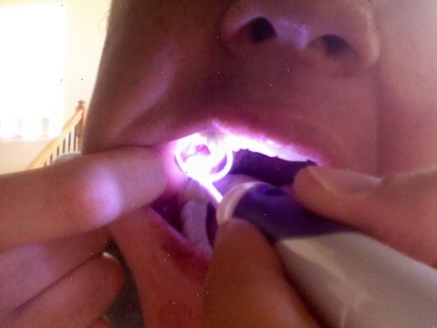 Hvordan behandle en tørr socket. Gå tilbake til oral kirurg eller tannlege.