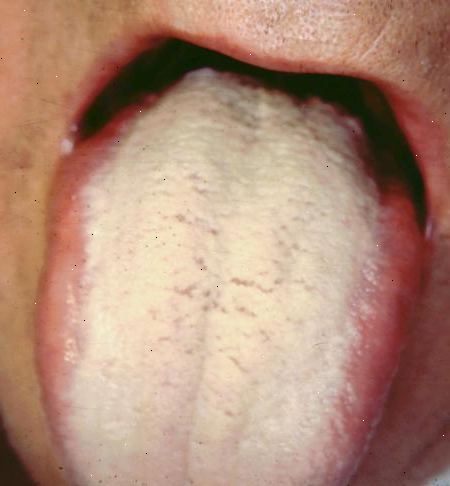 Hvordan bli kvitt hvit tunge. Starter på selve bunnen av tungen din, plasserer tungen renere helt inntil tungen overflate og gjør langsomme feiende strøk fra back-to-front.