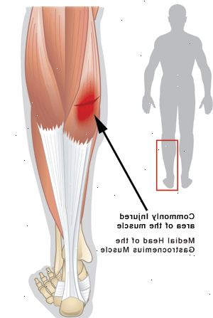 Hvordan diagnostisere en revet leggmuskelen. Innse at leggmuskelen er faktisk består av to muskler som er festet til hælen på baksiden av kneet.