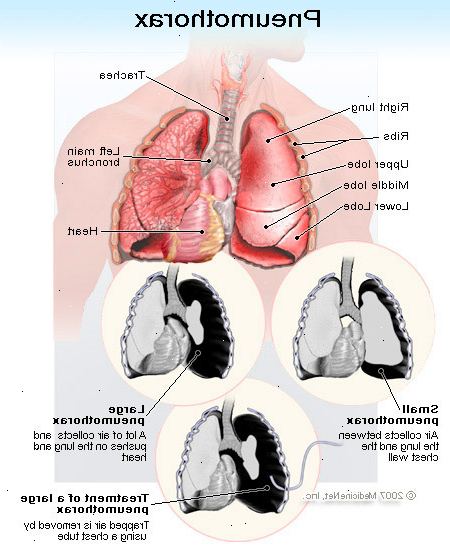 Hvordan helbrede fra en kollapset lunge. Gå til legen eller legevakten umiddelbart hvis du opplever plutselige brystsmerter på en side av brystet ditt i nærheten lunge.