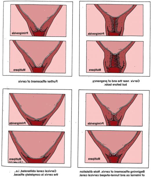 Hvordan strekke livmorhalsen. Se etter tegn på cervical dilatasjon hvis du er nær slutten av svangerskapet.