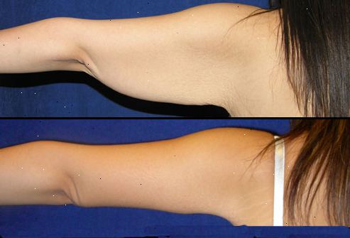 Hvordan bli kvitt underarm fett. Bygge muskler tone rundt armene.
