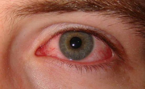 Hvordan å behandle rosa øye (konjunktivitt). Identifisere symptomer.