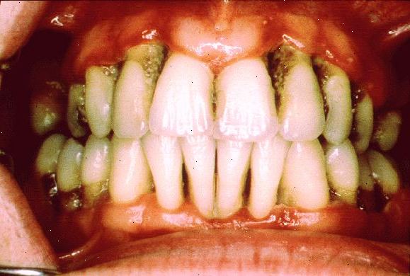Hvordan å behandle periodontal sykdom. Gå til tannlegen, som vil utføre en dyp rengjøring av tennene og tannkjøttet.