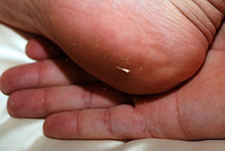 Hvordan fjerne en splint med natron. Rengjør og tørk flekk med såpe og vann.