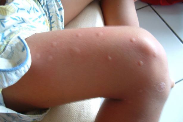 Hvordan stoppe myggstikk fra kløe. Håndtere de biter når de først oppstår.