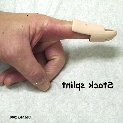 Hvordan å behandle klubbe finger med en skinne. Se en lege umiddelbart.