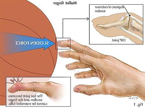 Hvordan å behandle en fastkjørt finger. Sørg for at skaden ikke har resultert i et beinbrudd.